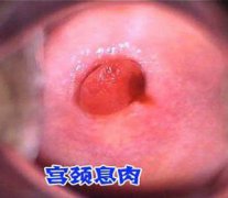 宫颈息肉注意事项
